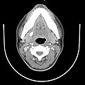 左側下頷腺與腺管內2顆結石:電腦斷層掃描