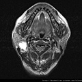 腮腺腫瘤 MRI  ,  parotid tumor
