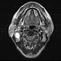 腮腺腫瘤 MRI ,  Parotid tumor