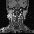 腮腺腫瘤 MRI , Parotid tumor