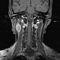 腮腺腫瘤 parotid tumor , MRI