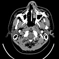 CT AXIAL 3.jpg