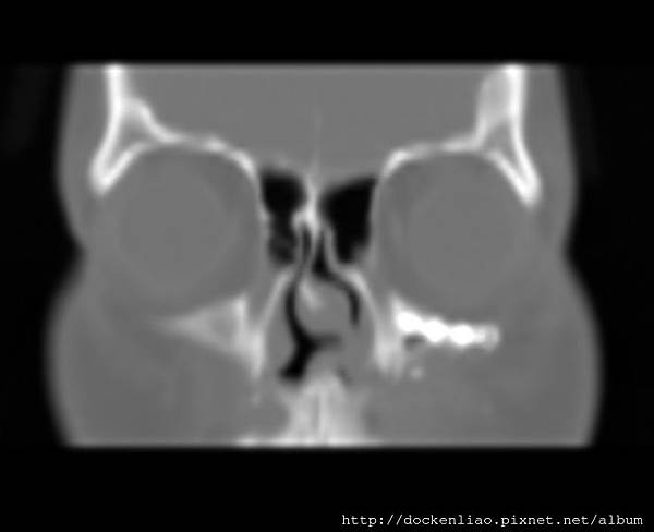 CT CORONAL 3.jpg