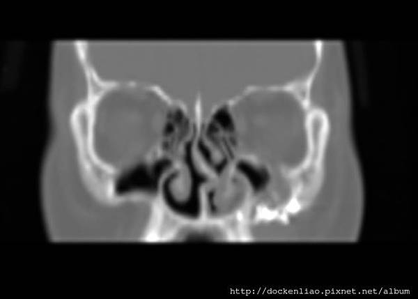 CT CORONAL 1.jpg