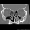 CT CORONAL 1.jpg