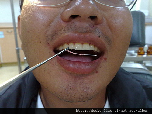 喉嚨卡魚刺 fish bone in throat