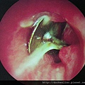 小兒誤吞硬幣 coin stuck in esophagus inlet