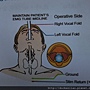 喉返神經監測系統 recurrent laryngeal nerve monitor system