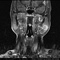 腮腺腫瘤 Parodit tumor, MRI