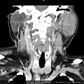 5公分腮腺腫瘤 CT  parotid tumor