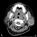5公分腮腺腫瘤  CT parotid tumor