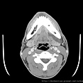 腮腺腫瘤 parotid tumor