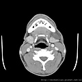 腮腺腫瘤 parotid tumor