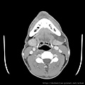 腮腺腫瘤 parotid tumor