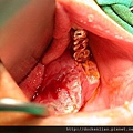 gingival ca 