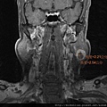 MRI MEASURE CORONAL.jpg