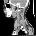 LEFT ELONGATED STYLOID PROCESS SAGITTAL