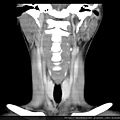 CT coronal 1