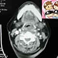 acute epiglottitis