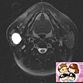 parotidm MRI2.jpg