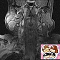 parotidm MRI6.jpg