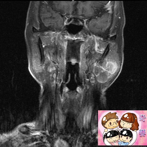 MRI PAROTID TUMOR CORONAL.jpg