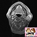 MRI PAROTID TUMOR.jpg