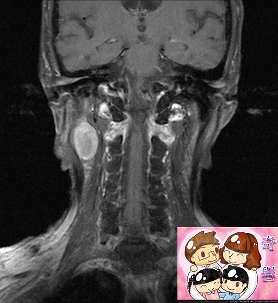 MRI CORONAL 2.jpg