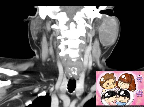 CT CORONAL 3.jpg