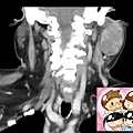 CT CORONAL 4.jpg