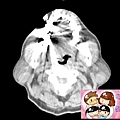 CT BILATERAL PAROTID TUMORS.jpg