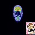 PET CT MOUTH FLOOR CA CORONAL.jpg