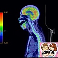 PET CT MOUTH FLOOR CA  SAGITTAL.jpg
