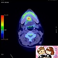 PET CT MOUTH FLOOR CA.jpg