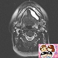 蝦蟆腫 核磁共振造影 ranula MRI