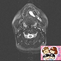 蝦蟆腫 核磁共振造影 ranula MRI