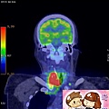 正子電腦斷層攝影 末期甲狀腺癌 ADVANCED THYROID CANCER