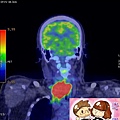 正子電腦斷層攝影 末期甲狀腺癌 ADVANCED THYROID CANCER