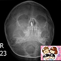 鼻腔內的鋰電池 Lithium battery in nasal cavity