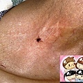 脖子皮膚吸血蜱 Tick on human neck skin 