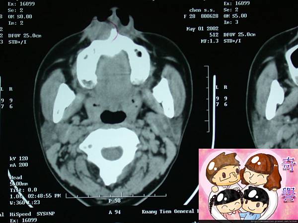 鼻翼囊腫 鼻齒槽囊腫