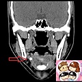 submandibular sialolith CT coronal mark.jpg