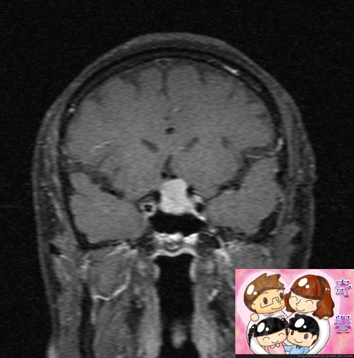 MRI PITUITARY GLAND TUMOR CORONAL 3.jpg