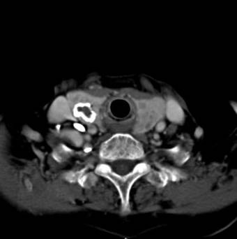 ring calcification