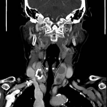 ring calcification coronal