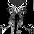 ring calcification coronal