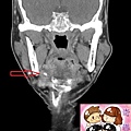 Submandibular sialolith CT coronal mark.jpg
