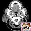 right parotid tumor CT 2.jpg