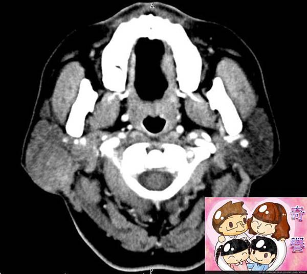 right parotid tumor CT 1.jpg