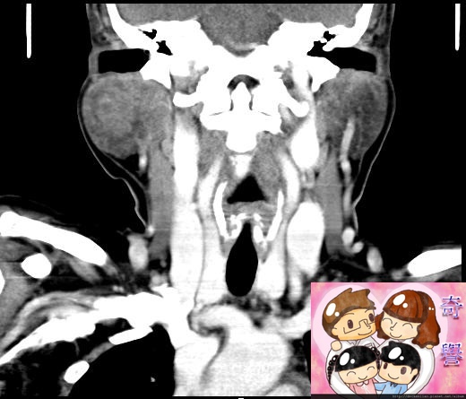 right parotid tumor CT coronal 1.jpg